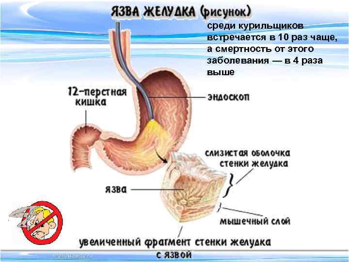 среди курильщиков встречается в 10 раз чаще, а смертность от этого заболевания — в
