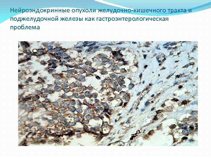 Нейроэндокринные опухоли желудочно-кишечного тракта и поджелудочной железы как гастроэнтерологическая проблема 