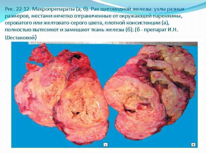 Рис. 22 -12. Макропрепараты (а, б). Рак щитовидной железы: узлы разных размеров, местами нечетко
