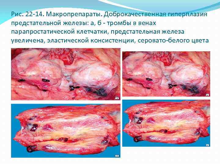 Рис. 22 -14. Макропрепараты. Доброкачественная гиперплазия предстательной железы: а, б - тромбы в венах