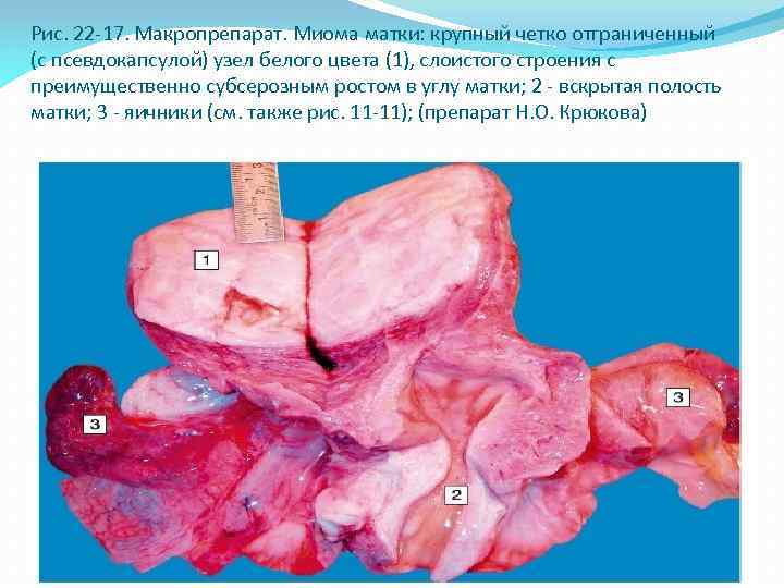 Рис. 22 -17. Макропрепарат. Миома матки: крупный четко отграниченный (с псевдокапсулой) узел белого цвета