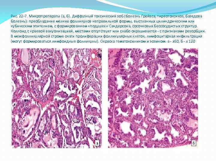 Рис. 22 -7. Микропрепараты (а, б). Диффузный токсический зоб (болезнь Грейвса, тиреотоксикоз, базедова болезнь):