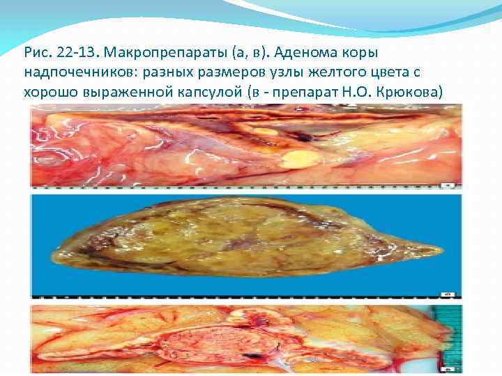 Рис. 22 -13. Макропрепараты (а, в). Аденома коры надпочечников: разных размеров узлы желтого цвета