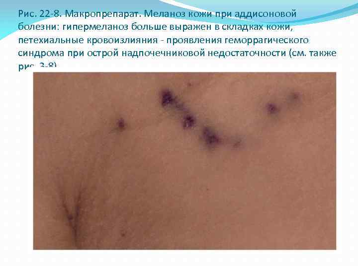 Рис. 22 -8. Макропрепарат. Меланоз кожи при аддисоновой болезни: гипермеланоз больше выражен в складках