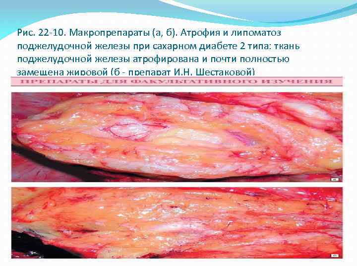Рис. 22 -10. Макропрепараты (а, б). Атрофия и липоматоз поджелудочной железы при сахарном диабете
