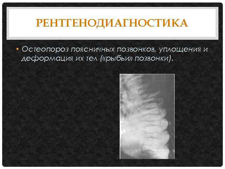 РЕНТГЕНОДИАГНОСТИКА • Остеопороз поясничных позвонков, уплощения и деформация их тел ( «рыбьи» позвонки). 