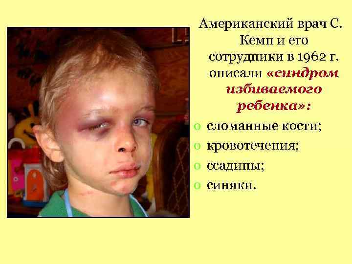 Американский врач С. Кемп и его сотрудники в 1962 г. описали «синдром избиваемого ребенка»