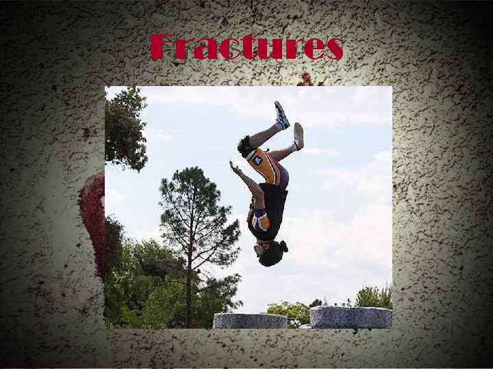 Fractures 