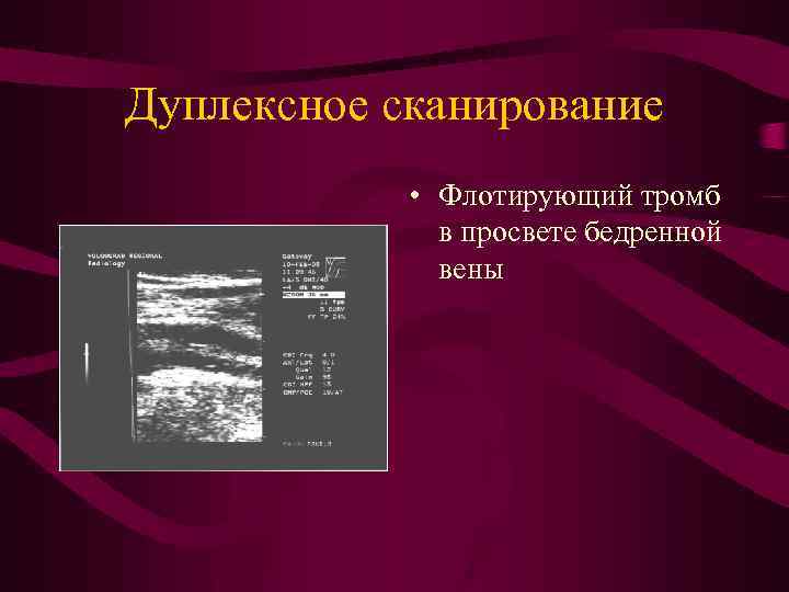 Дуплексное сканирование • Флотирующий тромб в просвете бедренной вены 