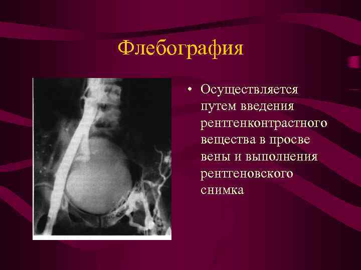 Флебография • Осуществляется путем введения рентгенконтрастного вещества в просве вены и выполнения рентгеновского снимка