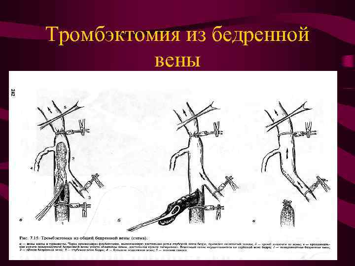 Тромбэктомия из бедренной вены 