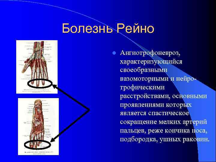 Болезнь Рейно l Ангиотрофоневроз, характеризующийся своеобразными вазомоторными и нейротрофическими расстройствами, основными проявлениями которых является