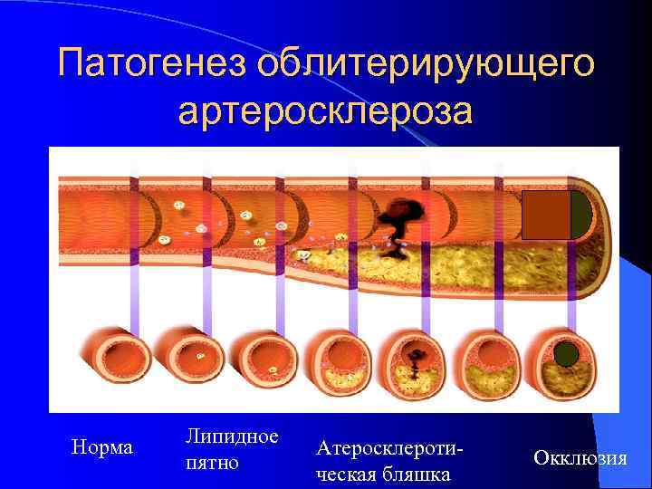 Облитерирующий атеросклероз картинки