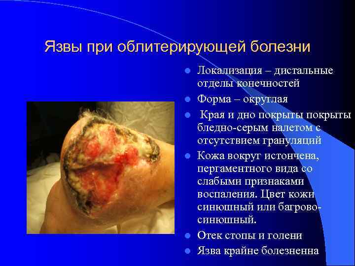 Язвы при облитерирующей болезни l l l Локализация – дистальные отделы конечностей Форма –