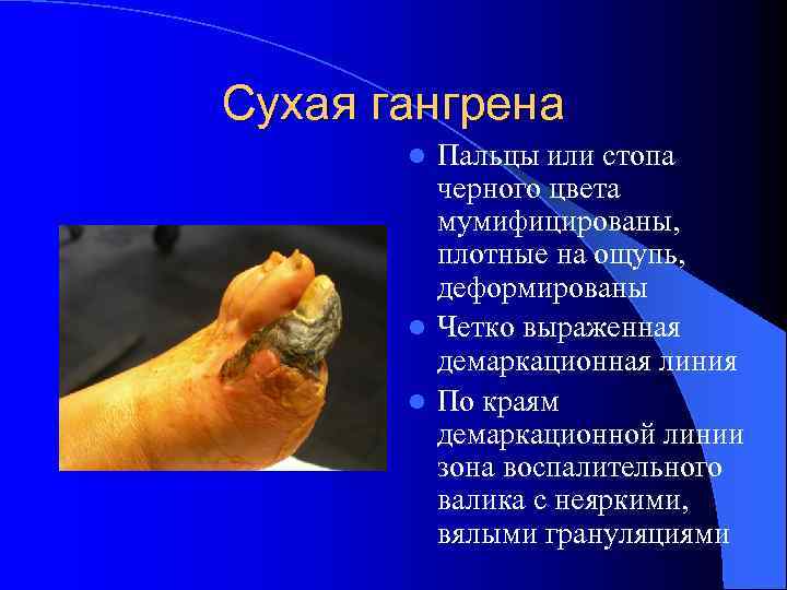 Сухая гангрена Пальцы или стопа черного цвета мумифицированы, плотные на ощупь, деформированы l Четко