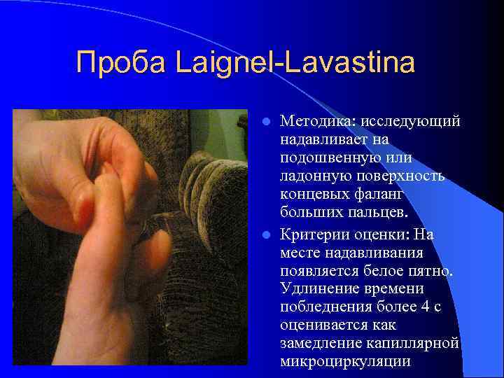 Проба Laignel-Lavastina Методика: исследующий надавливает на подошвенную или ладонную поверхность концевых фаланг больших пальцев.