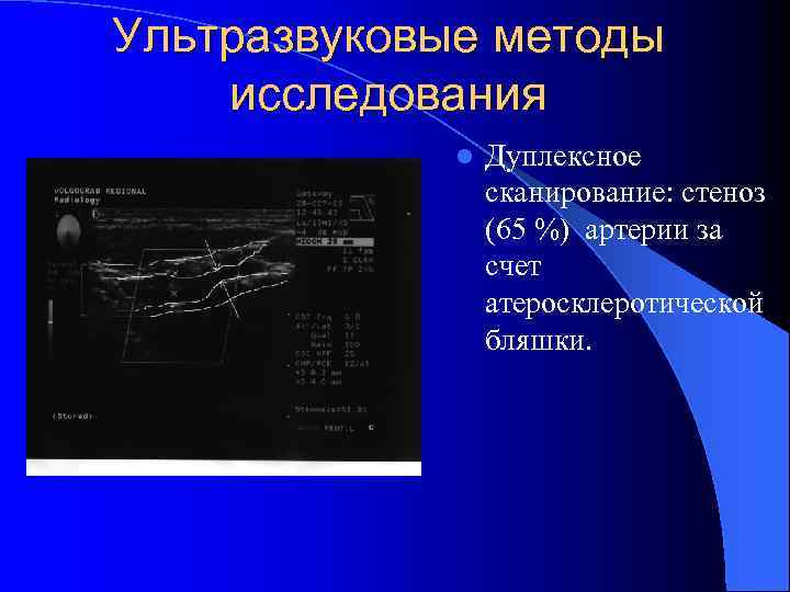Ультразвуковые методы исследования l Дуплексное сканирование: стеноз (65 %) артерии за счет атеросклеротической бляшки.