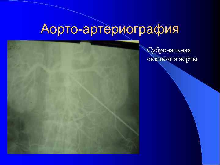 Аорто-артериография Субренальная окклюзия аорты 