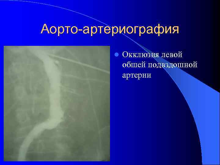 Аорто-артериография l Окклюзия левой обшей подвздошной артерии 