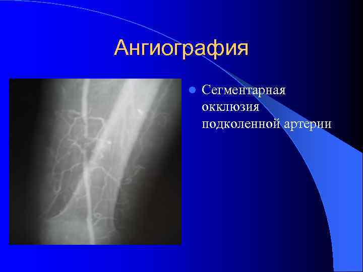 Ангиография l Сегментарная окклюзия подколенной артерии 
