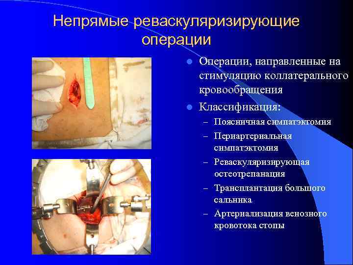 Непрямые реваскуляризирующие операции Операции, направленные на стимуляцию коллатерального кровообращения l Классификация: l – Поясничная