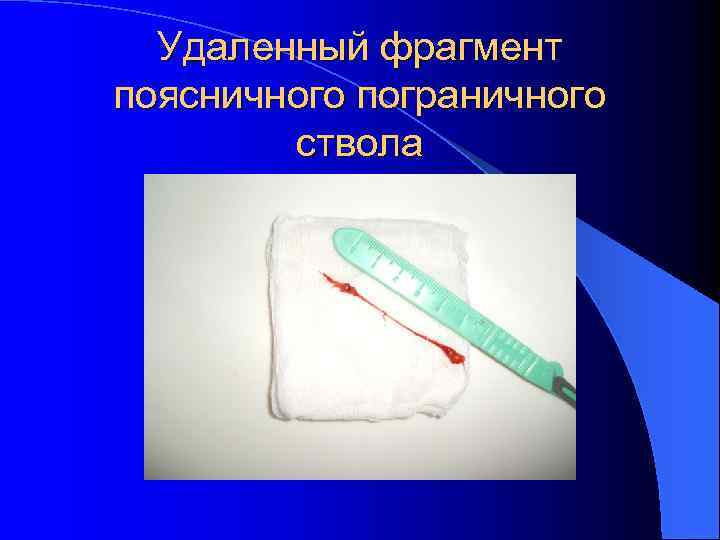 Удаленный фрагмент поясничного пограничного ствола 