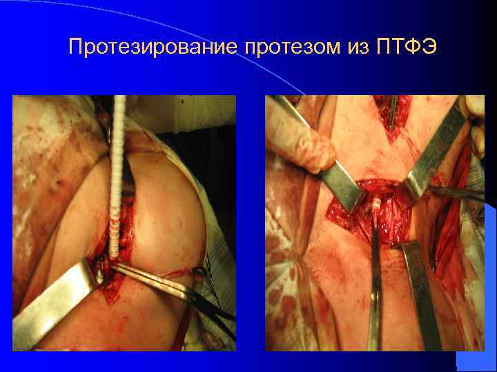 Протезирование протезом из ПТФЭ 