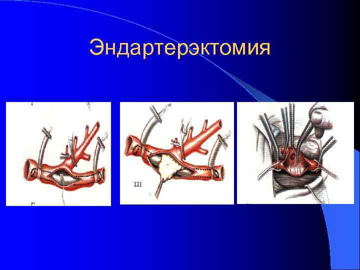 Нарушение артериального. Эндартерэктомия нижних конечностей. Нарушение артериального кровоснабжения нижних конечностей. Нарушен артериальный кровоток ног. Оценка кровоснабжения конечности алгоритм.