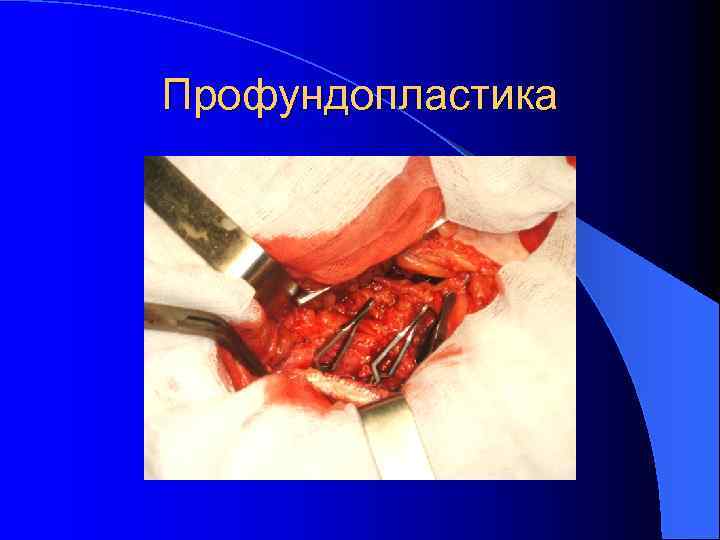 Профундопластика 
