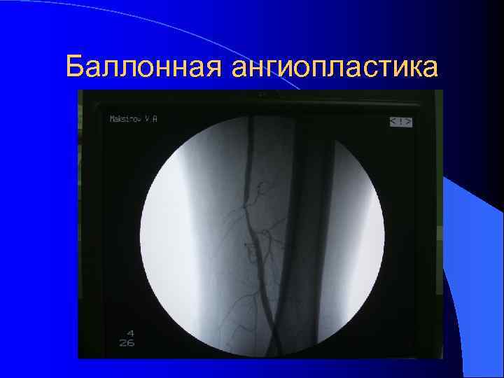 Баллонная ангиопластика 