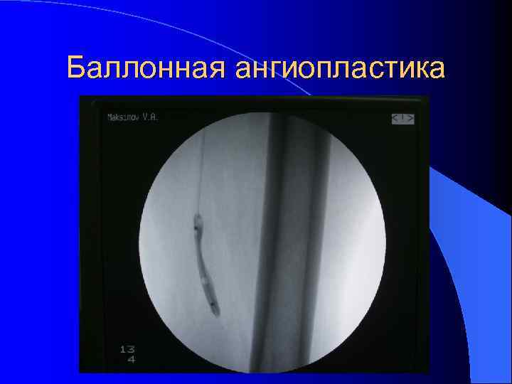 Баллонная ангиопластика 