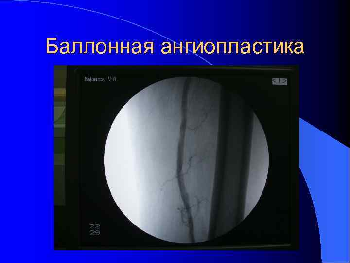 Баллонная ангиопластика 