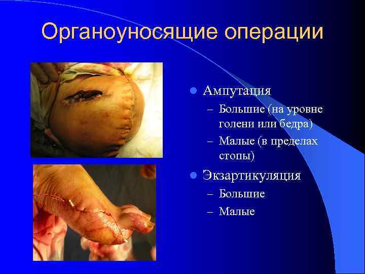 Органоуносящие операции l Ампутация – Большие (на уровне голени или бедра) – Малые (в