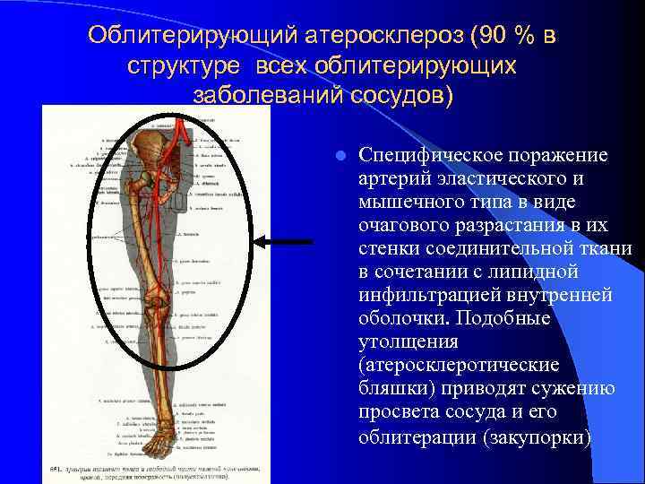 Облитерирующий атеросклероз (90 % в структуре всех облитерирующих заболеваний сосудов) l Специфическое поражение артерий