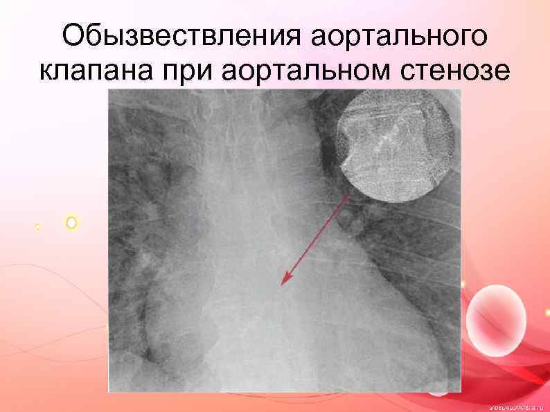 Обызвествления аортального клапана при аортальном стенозе 