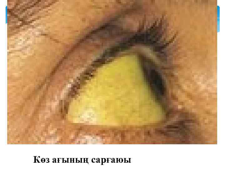 Көз ағының сарғаюы 