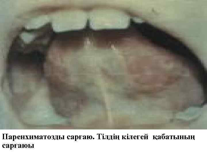 Паренхиматозды сарғаю. Тілдің кілегей қабатының сарғаюы 