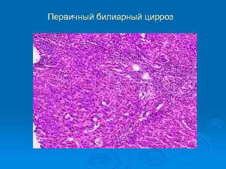 Первичный билиарный цирроз 
