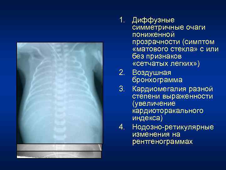 Матовое стекло в легких. Симптом матового стекла рентген. Матовое стекло рентген признак. «Сиптом матового стекла. Матовое стекло на рентгенограмме.