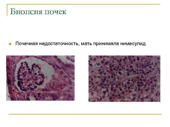 Биопсия почек n Почечная недостаточность, мать принимала нимесулид 