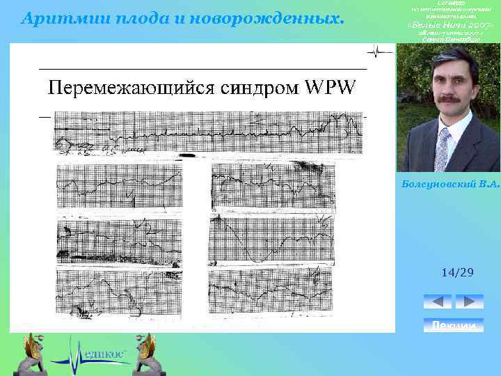 Аритмии плода и новорожденных. Болсуновский В. А. 14/29 Лекции 