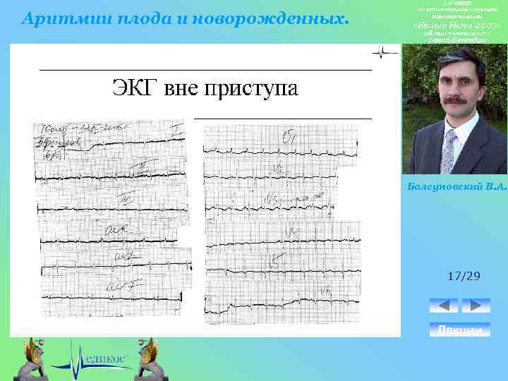 Аритмии плода и новорожденных. Болсуновский В. А. 17/29 Лекции 