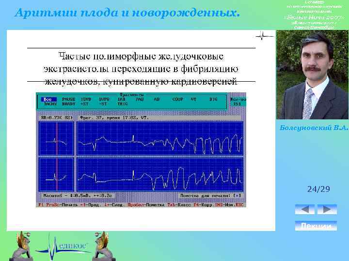 Аритмии плода и новорожденных. Болсуновский В. А. 24/29 Лекции 