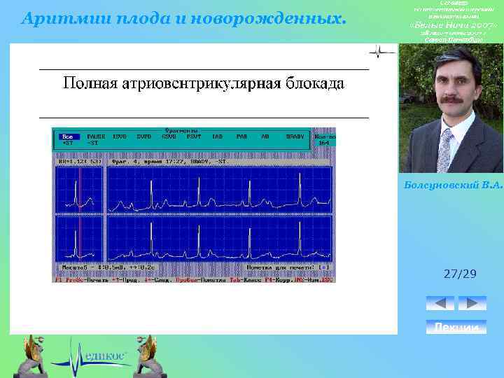 Аритмии плода и новорожденных. Болсуновский В. А. 27/29 Лекции 