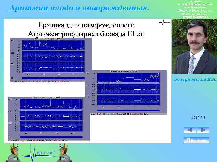 Аритмии плода и новорожденных. Болсуновский В. А. 28/29 Лекции 