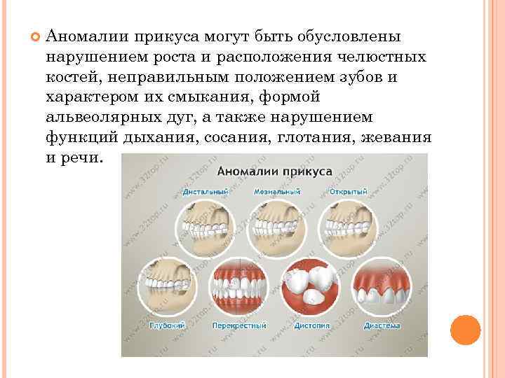  Аномалии прикуса могут быть обусловлены нарушением роста и расположения челюстных костей, неправильным положением