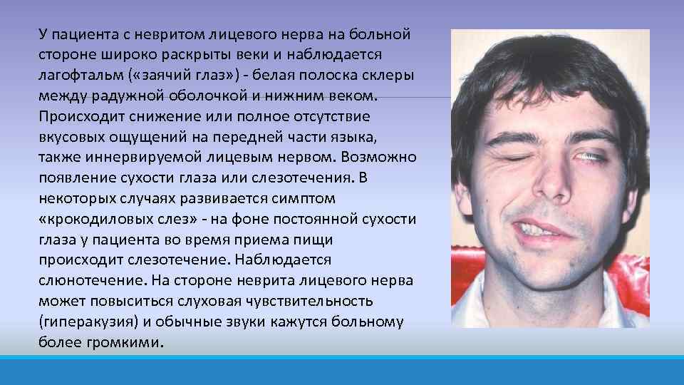 У пациента с невритом лицевого нерва на больной стороне широко раскрыты веки и наблюдается
