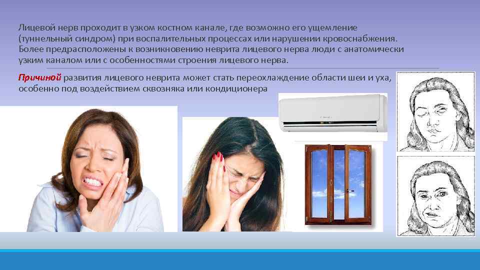  Лицевой нерв проходит в узком костном канале, где возможно его ущемление (туннельный синдром)