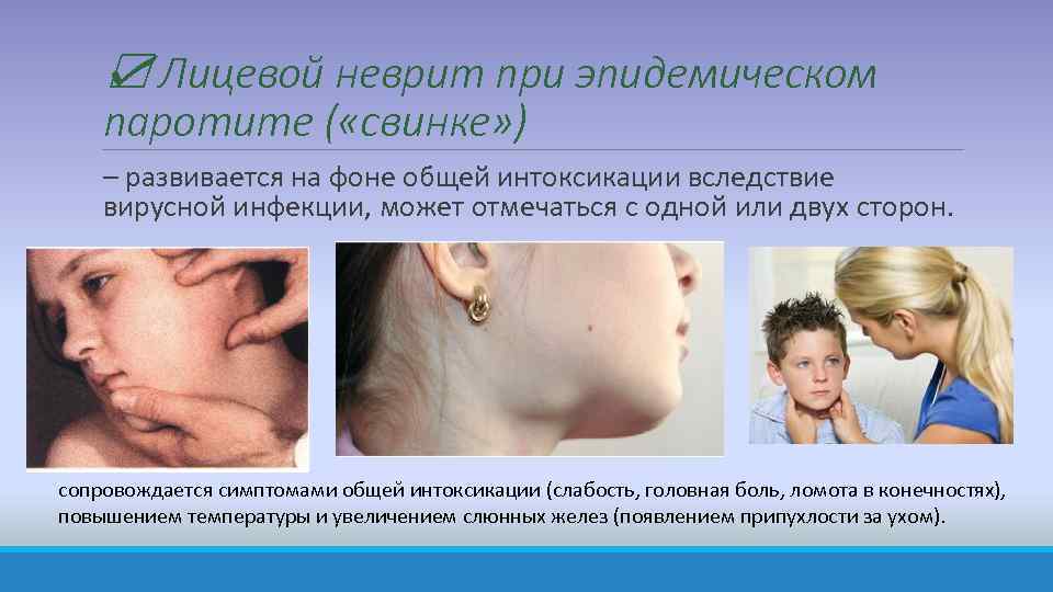 ☑ Лицевой неврит при эпидемическом паротите ( «свинке» ) – развивается на фоне общей
