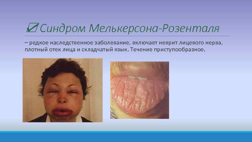 ☑ Синдром Мелькерсона-Розенталя – редкое наследственное заболевание, включает неврит лицевого нерва, плотный отек лица